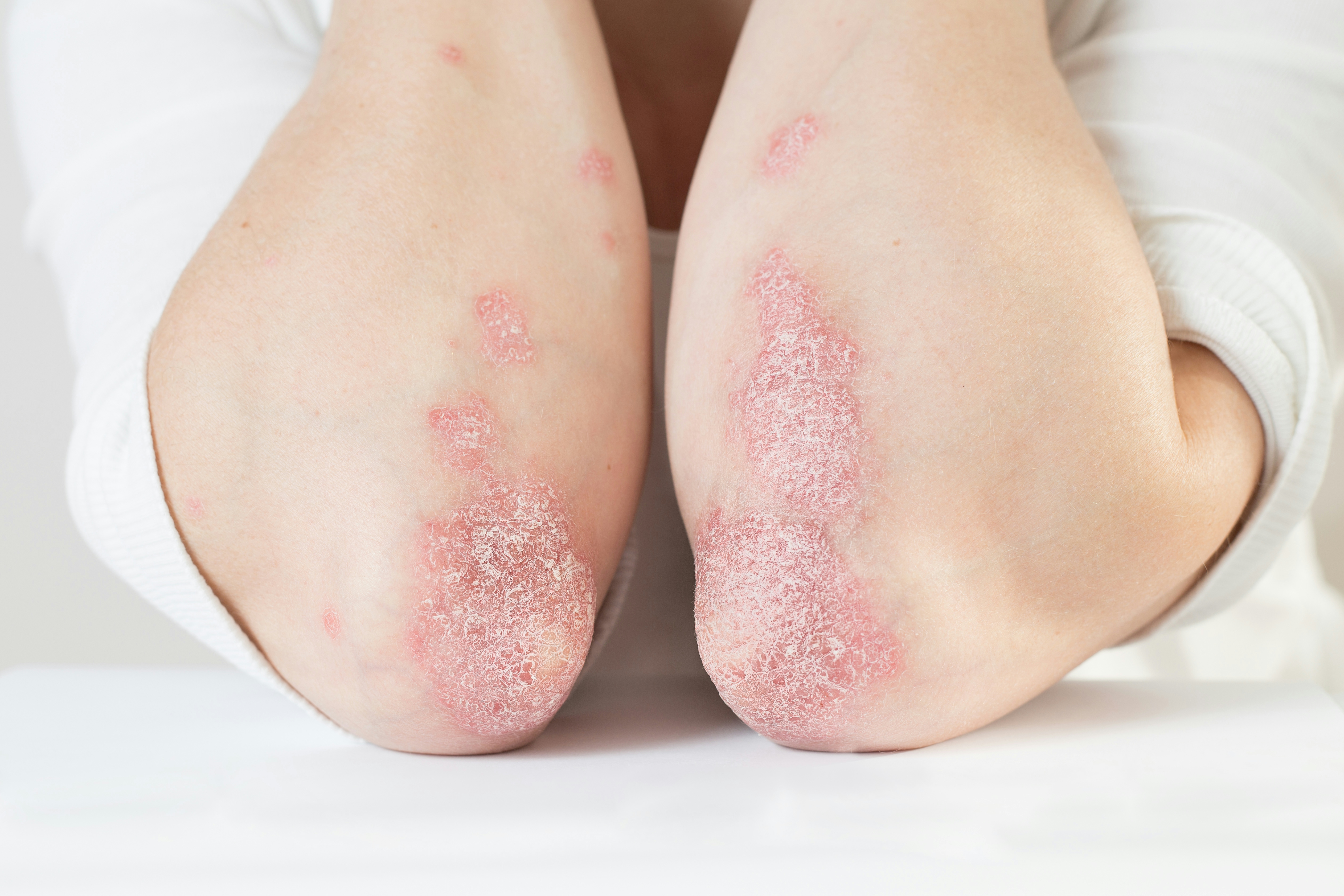 The Best Weed Strains For Psoriasis & Skincare
