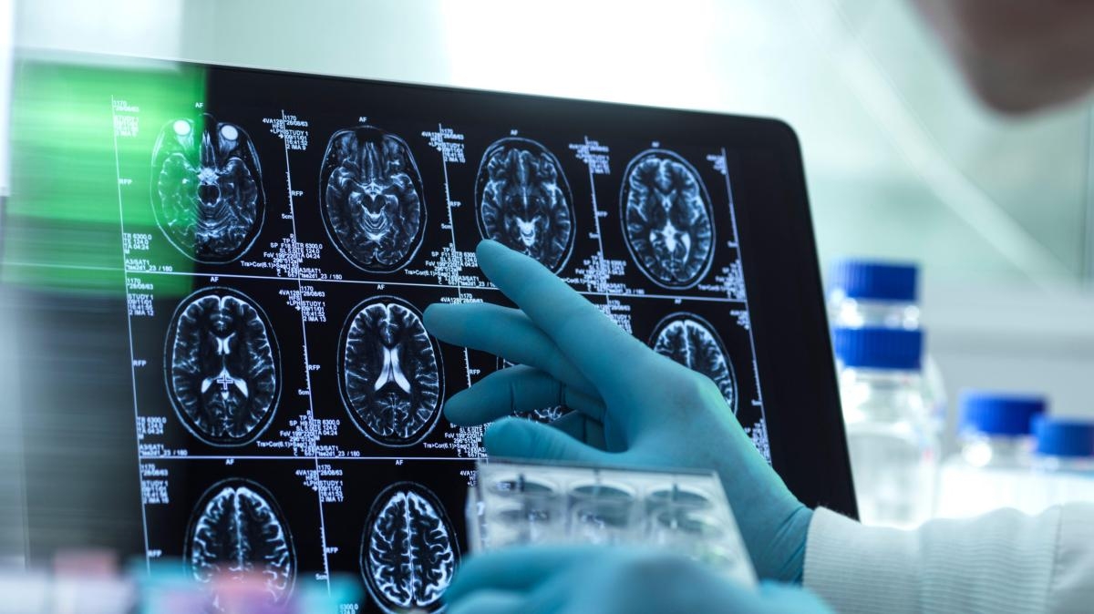AI Is Being Used To Study Who Will Develop Dementia
